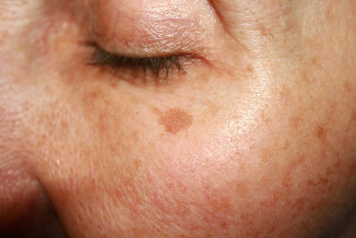 Brown spots under the eye. Pigmentation on the face.